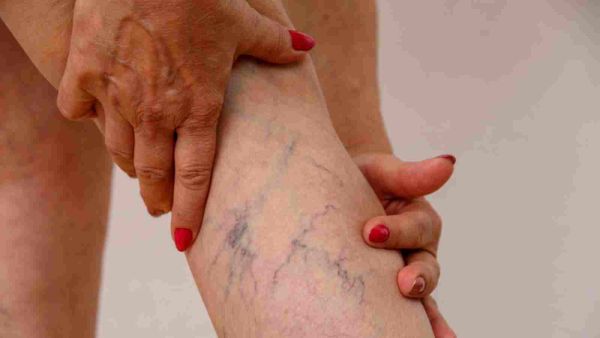 كما هو الحال مع دوالي الساقين تحدث دوالي المهبل للأعضاء التناسلية الأنثوية