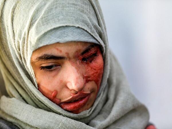 Al-Anoud Hussain Sheryan, a 19-year-old girl disfigured in an acid attack by her abusive husband, sits at a hospital where she is undergoing treatment in Yemen's capital Sanaa on January 28, 2021. Married at the age of 12, rejected at 16, and then disfigured in an acid attack, Sheryan's fate is a shocking illustration of abuse in a society beset by war and poverty. Now aged 19, the young Yemeni woman agreed to relate her ordeal at the hands of her abusive husband -- rare testimony in a country where domesti