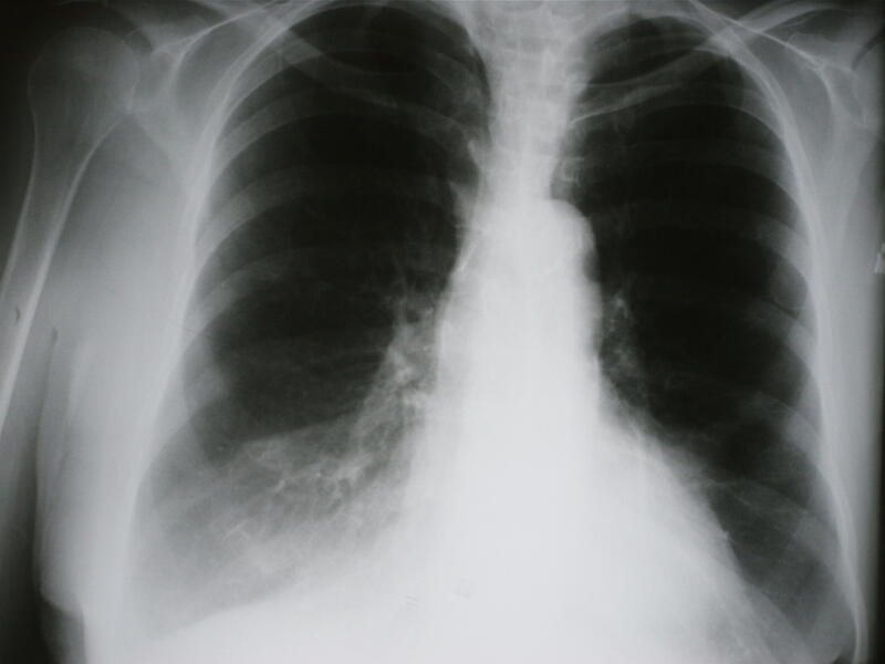 Xray of Chronic Obstructive Pulmonary Disease (Shutterstock)	