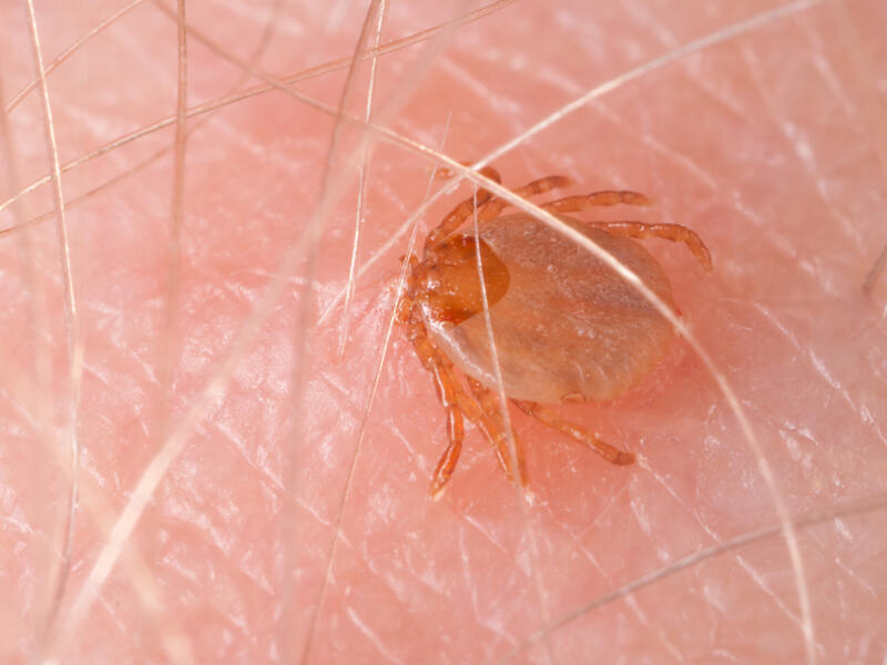 Maculosa fever tick drinking blood biting human skin - Typhoid typhus  (Shutterstock)	