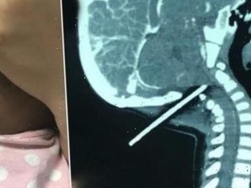 قضيب فولاذي يخترق رأس طفل صيني