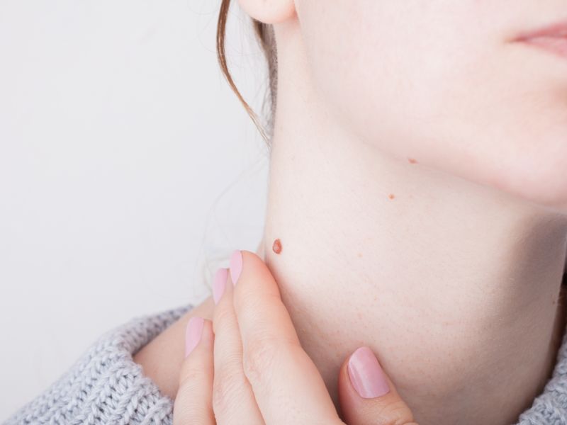 طبيب البوابة: طرق علاج التقرن الدهني (Seborrheic keratosis) 