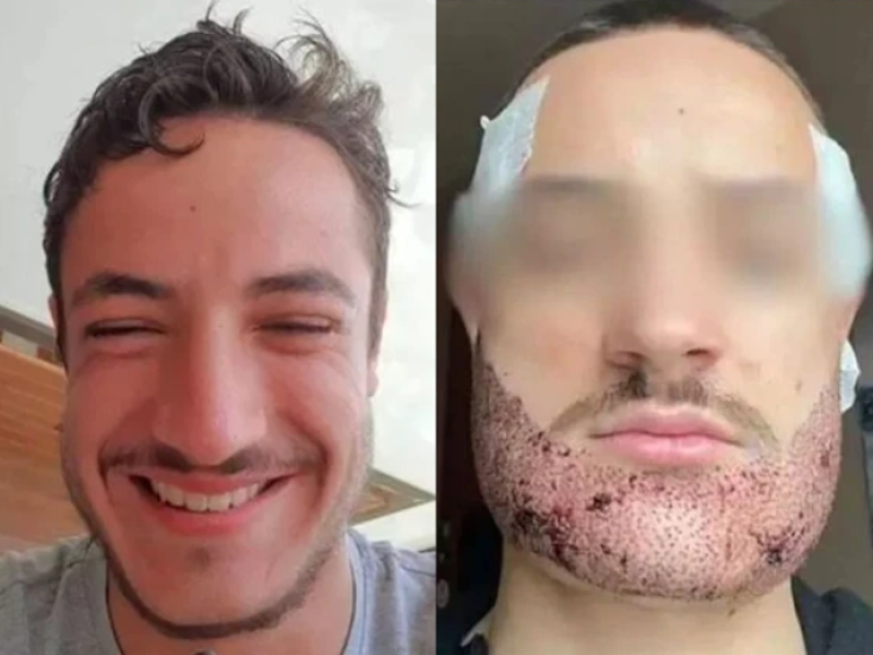 انتحار شاب فرنسي بعد فشل عملية زراعة اللحية