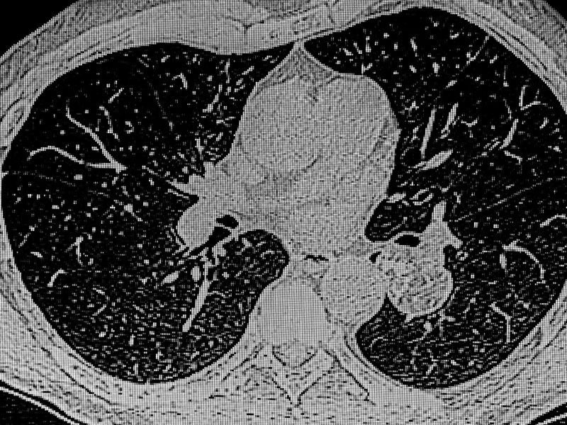 رئة الفشار: الأسباب، الأعراض، طرق العلاج
