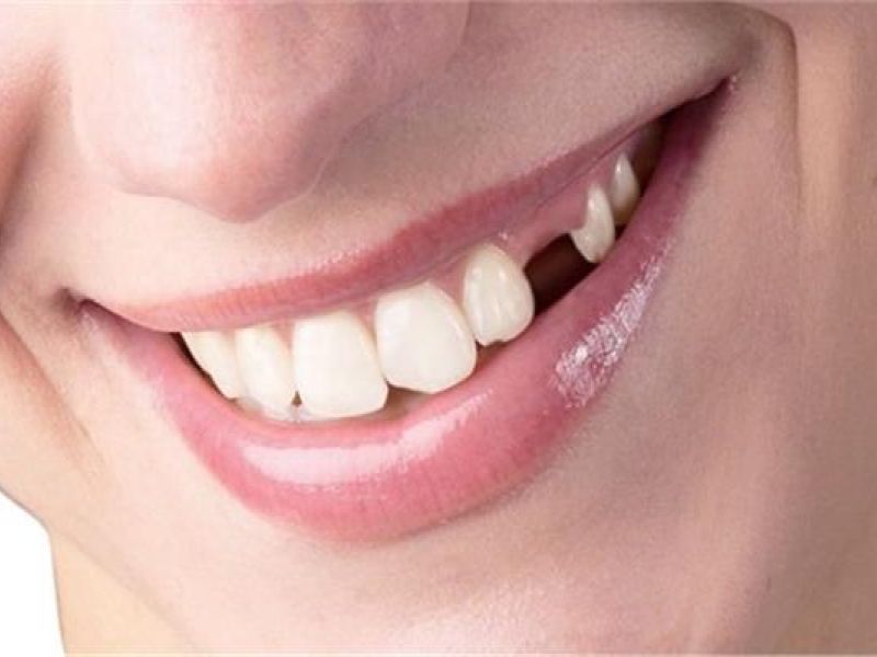 تفسير حلم كسر جزء من السن الأمامي للمتزوجة