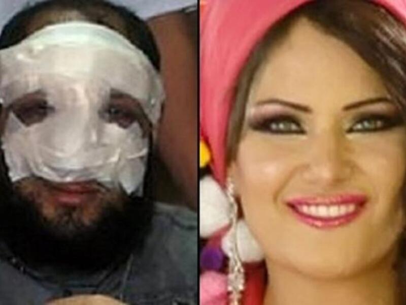 Anwar al-Balkimy post-nose-op and his rumored belly-dancer wife