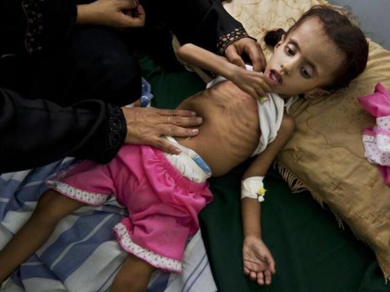 Yemen issues: Starving child in Yemen 