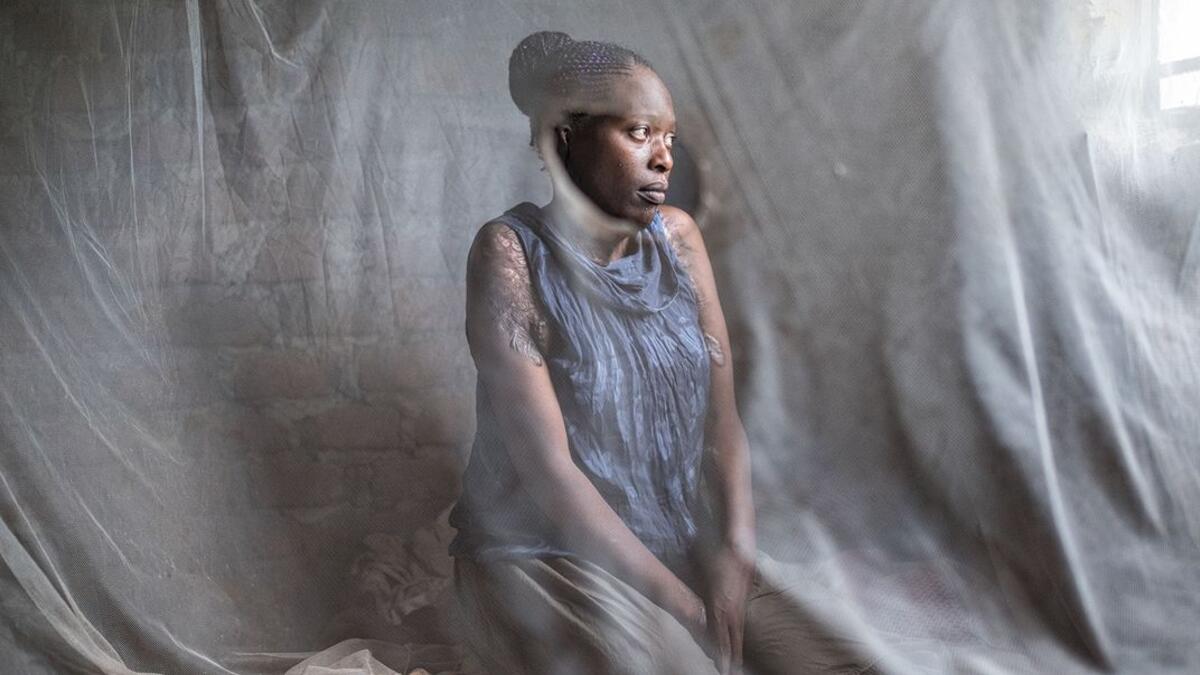 صورة بعنوان (نالومو) للمصور Erberto Zani: تظهر السيدة "نالومو مينسا" التي نجت من هجوم بالأسيد من قبل رجل مجهول في كامبالا عام 2014.