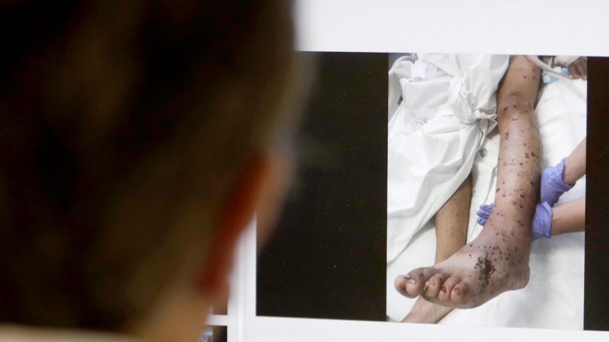 Lebanese doctor Selim Nasser displays the image of a patient's body who was hit by small lead pellets. ANWAR AMRO / AFP