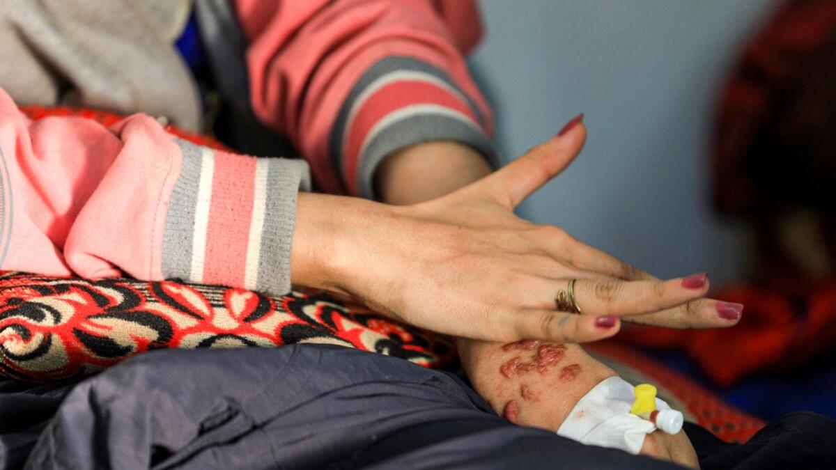 Al-Anoud Hussain Sheryan, a 19-year-old girl disfigured in an acid attack by her abusive husband, holds her hands together as she sits at a hospital where she is undergoing treatment in Yemen's capital Sanaa on January 28, 2021. Married at the age of 12, rejected at 16, and then disfigured in an acid attack, Sheryan's fate is a shocking illustration of abuse in a society beset by war and poverty. Now aged 19, the young Yemeni woman agreed to relate her ordeal at the hands of her abusive husband -- rare test