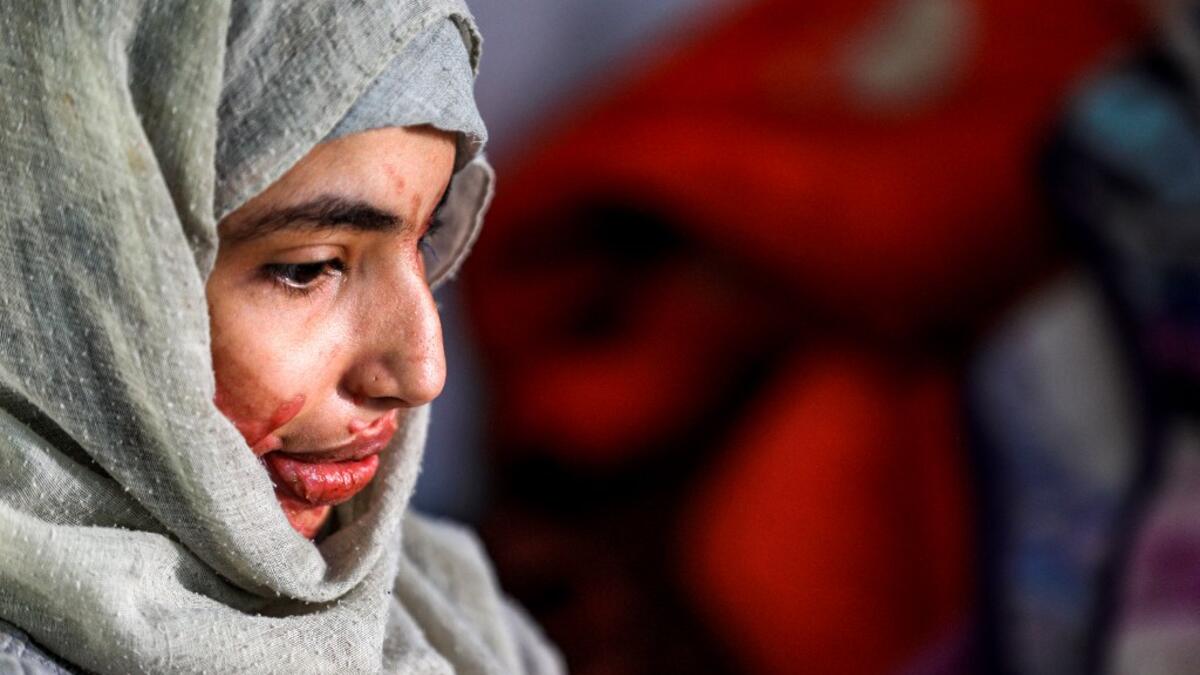Al-Anoud Hussain Sheryan, a 19-year-old girl disfigured in an acid attack by her abusive husband, sits at a hospital where she is undergoing treatment in Yemen's capital Sanaa on January 28, 2021. Married at the age of 12, rejected at 16, and then disfigured in an acid attack, Sheryan's fate is a shocking illustration of abuse in a society beset by war and poverty. Now aged 19, the young Yemeni woman agreed to relate her ordeal at the hands of her abusive husband -- rare testimony in a country where domesti