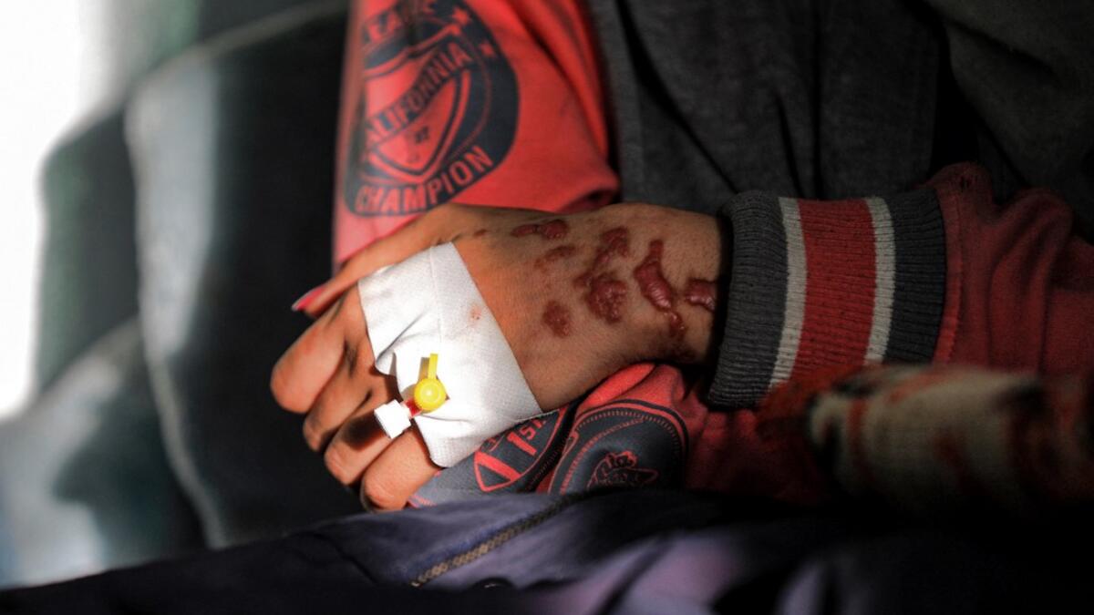 Al-Anoud Hussain Sheryan, a 19-year-old girl disfigured in an acid attack by her abusive husband, clasps her arm as she sits at a hospital where she is undergoing treatment in Yemen's capital Sanaa on January 28, 2021. Married at the age of 12, rejected at 16, and then disfigured in an acid attack, Sheryan's fate is a shocking illustration of abuse in a society beset by war and poverty. Now aged 19, the young Yemeni woman agreed to relate her ordeal at the hands of her abusive husband -- rare testimony in a