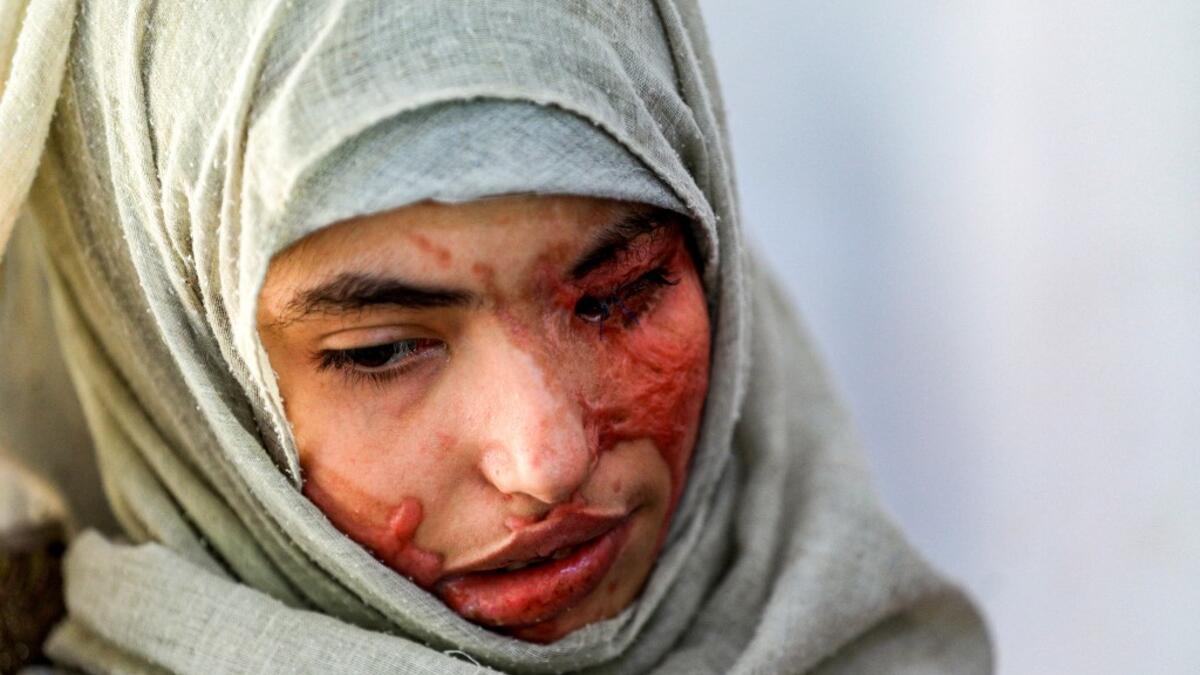 Al-Anoud Hussain Sheryan, a 19-year-old girl disfigured in an acid attack by her abusive husband, sits at a hospital where she is undergoing treatment in Yemen's capital Sanaa on January 28, 2021. Married at the age of 12, rejected at 16, and then disfigured in an acid attack, Sheryan's fate is a shocking illustration of abuse in a society beset by war and poverty. Now aged 19, the young Yemeni woman agreed to relate her ordeal at the hands of her abusive husband -- rare testimony in a country where domesti
