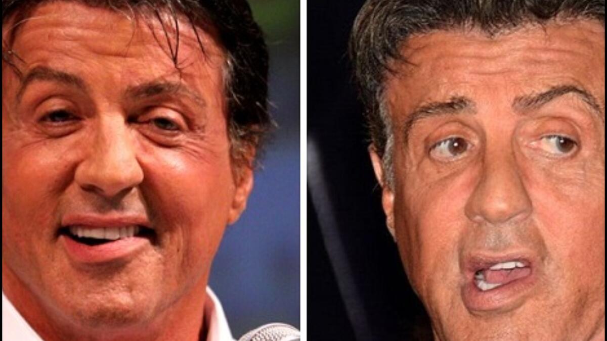 سيلفستر ستالون: شُخص نجم هوليوود بشلل بيل منذ ولادته نتيجة مضاعفات عند الولادة وهو ما تسبب في شلل الجانب الأيسر من الوجه وأعطته ابتسامة ملتوية قليلًا ولسان نصف مشلول إذ كما عانى نتيجة لذلك من مشكلة في النطق.