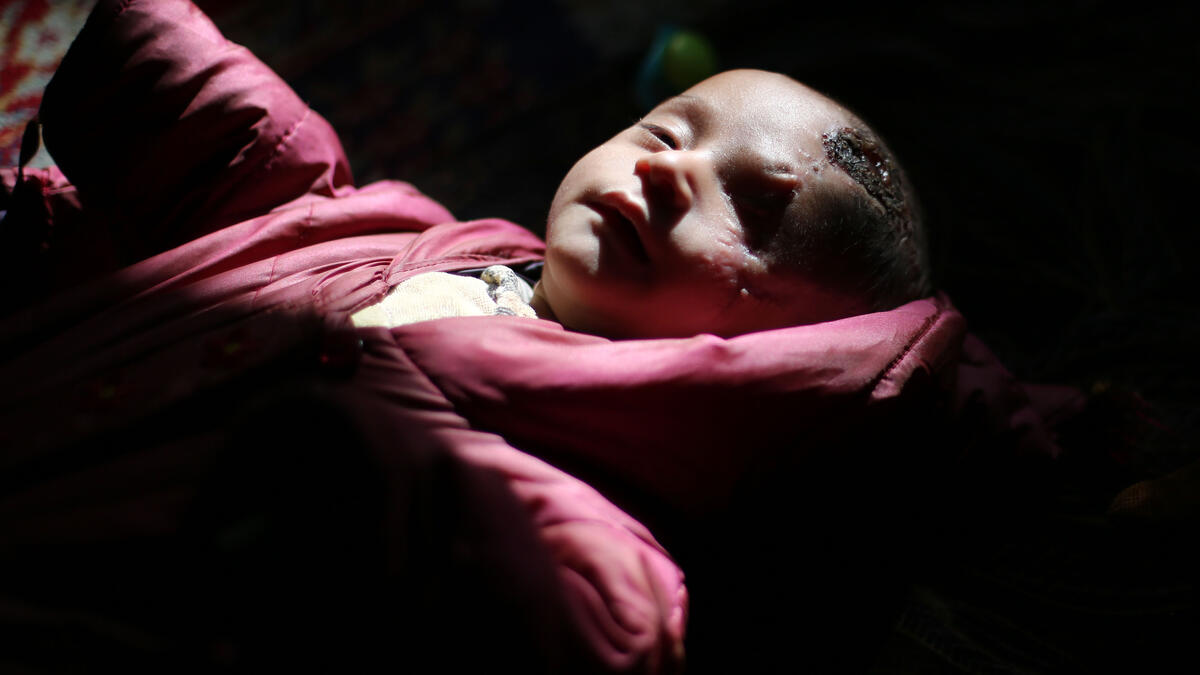 Blinded and seriously injured, baby Karim Abdallah becomes a symbol of Eastern Ghouta Siege /AFP