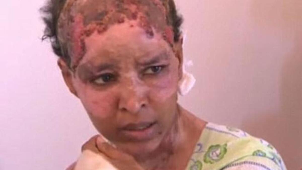 Another leaked relic of the regime: Burnt, blistered and left to rot in the plush Gaddafi house, Ethiopian nanny. She escaped Libya
& Gaddafi hell this weekend, offered sanctuary in Malta after heart-rending ordeal 'at the Gaddafi's'. Nanny to 
Hannibal's tribe, she was abused with scolding hot water for not complying with wife Aline's demands.
