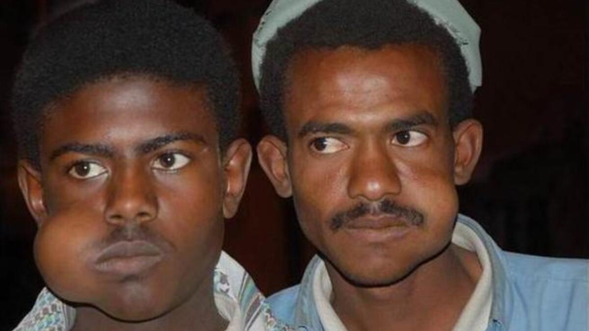 Qat is a small evergreen shrub, widely cultivated in Yemen and generally used for chewing, with stimulant drug effect. Chewing also part of the Yemeni business culture to promote decision-making.