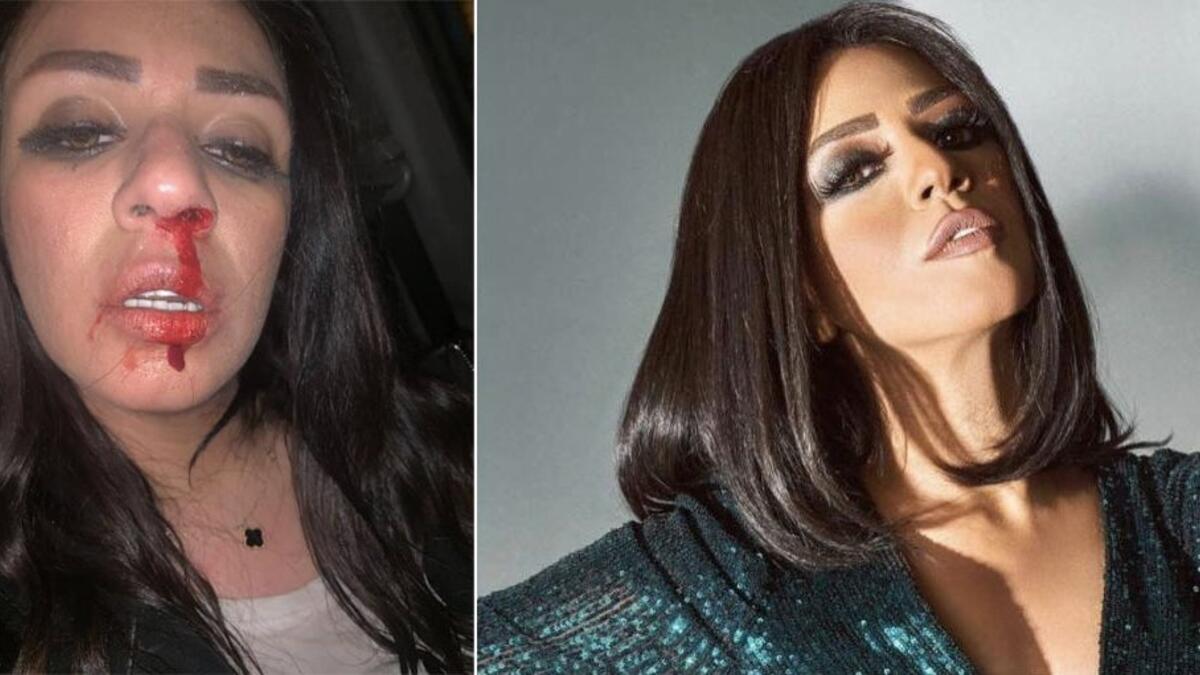 أعلنت المطربة المصرية شاهيناز عن تعرضها للضرب من زوجها السابق إيهاب، بعد أيام من إعلان انفصالها عنه بعد زواج دام 3 سنوات.