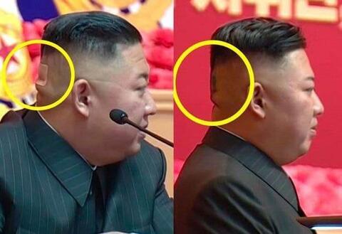 ندبة في رأس كيم جونغ أون تثير جدلا حول صحته