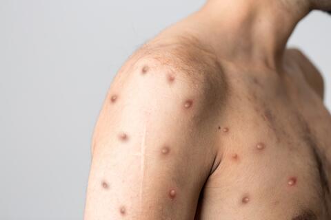 Monkeypox: New York Declared as a Disaster Emergency Area 