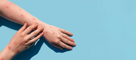 Sudan Discovers Seven Monkeypox Cases