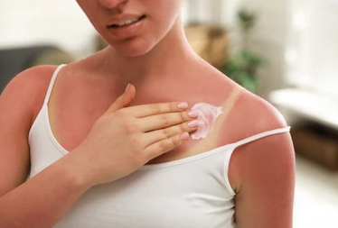 Fast and effective home remedies for treating sunburn