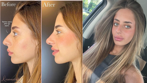 Recent Israeli hostage Mia Schem gets nose job