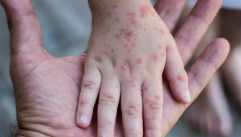 ينتقل عبر التنفس.. هل يعيد جدري القرود 