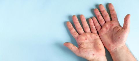 What is Mpox, what are the symptoms?