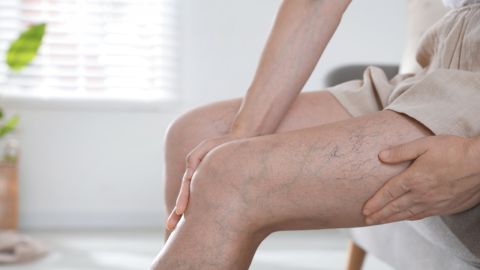 وصفات طبيعية لعلاج دوالي الساقين