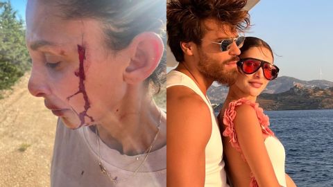 Can Yaman’s girlfriend DJ Sara Bluma posts bloody photos, accuses ex of abuse and child denial